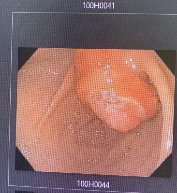 Endoscopia digestiva alta mostrando lesão subepitelial gástrica na incisura angular